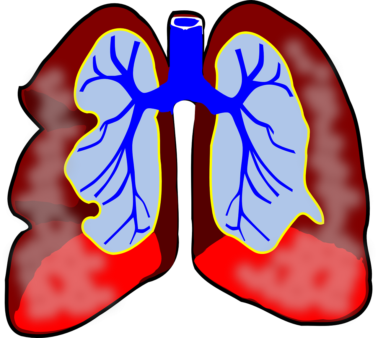allergic asthma