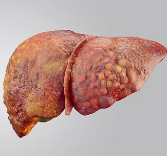 NAFLD