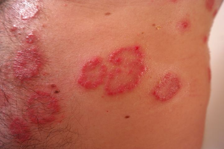 skin rashes