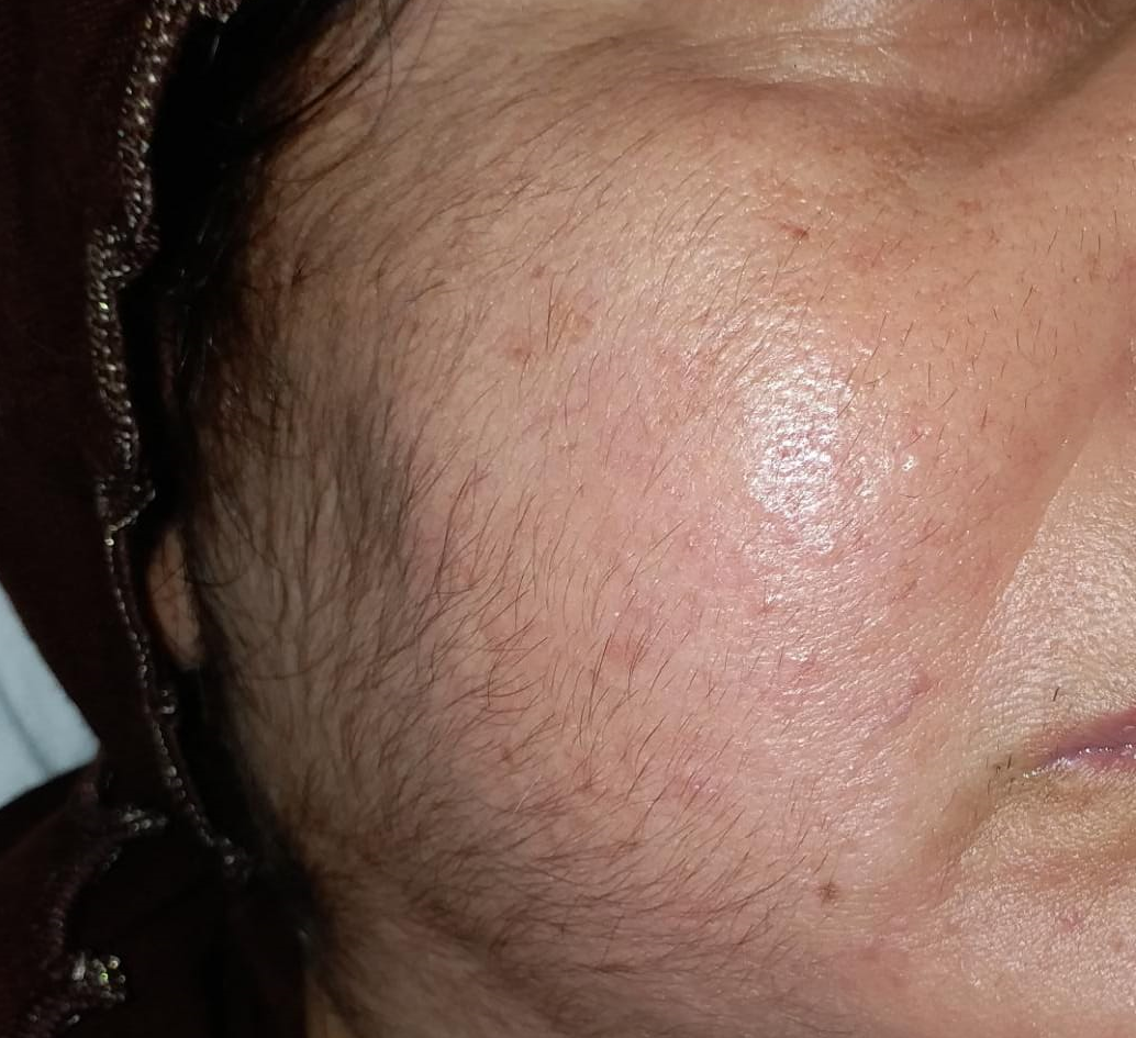 facial hair in women