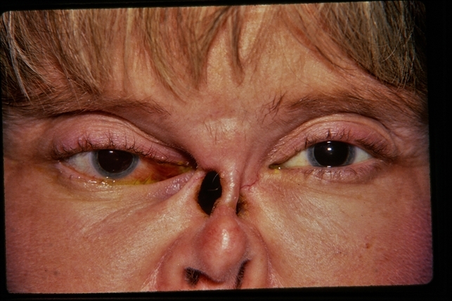 wegener's granulomatosis
