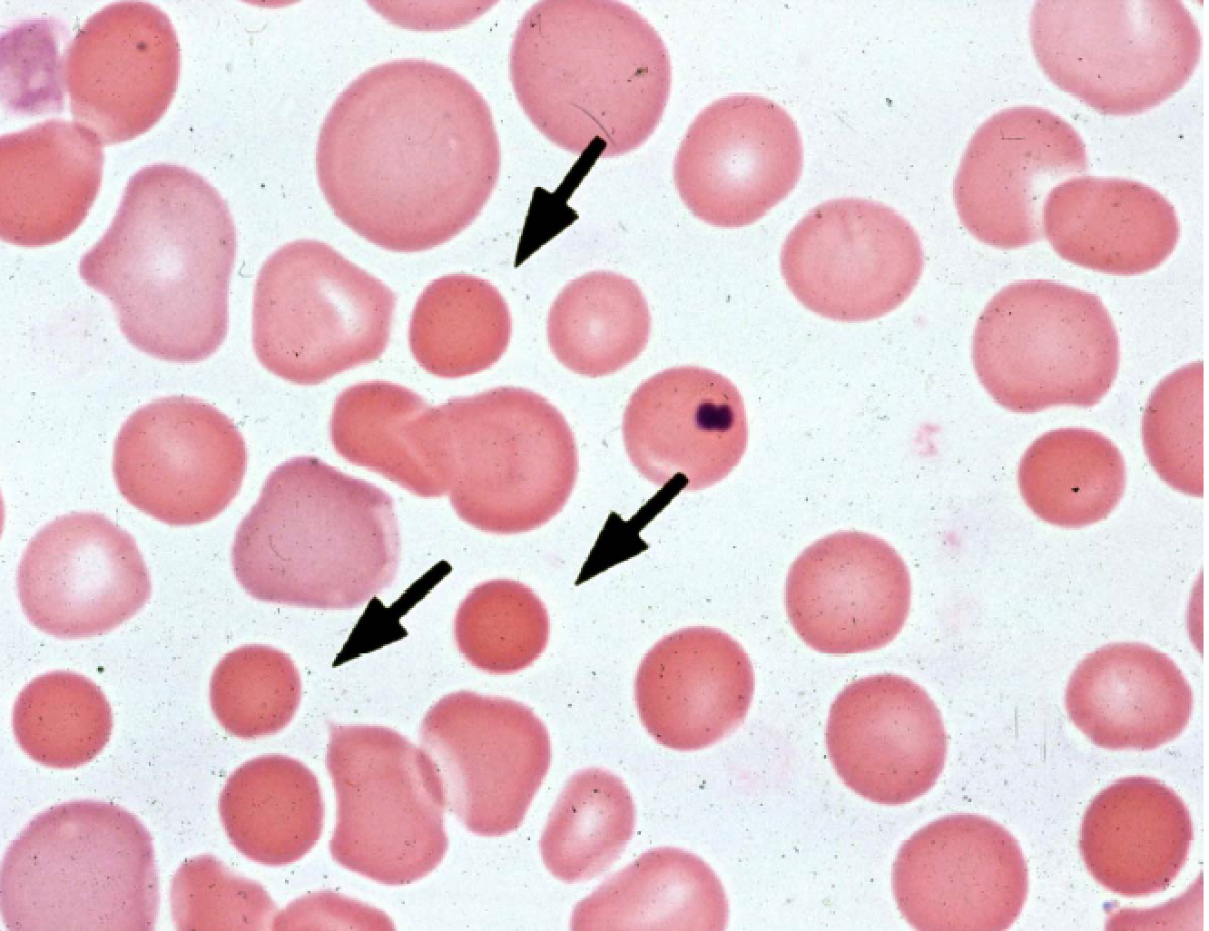 hereditary spherocytosis