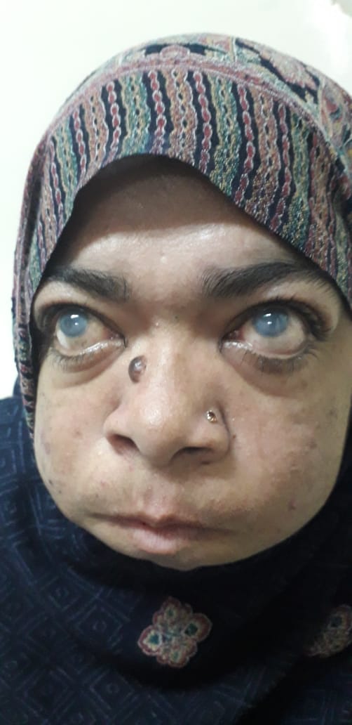 mucopolysaccharidosis