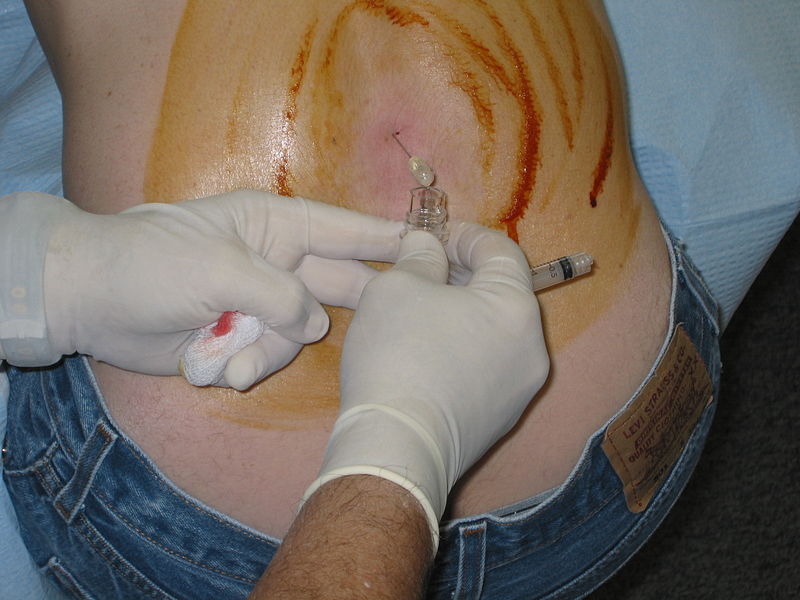 lumbar puncture procedure