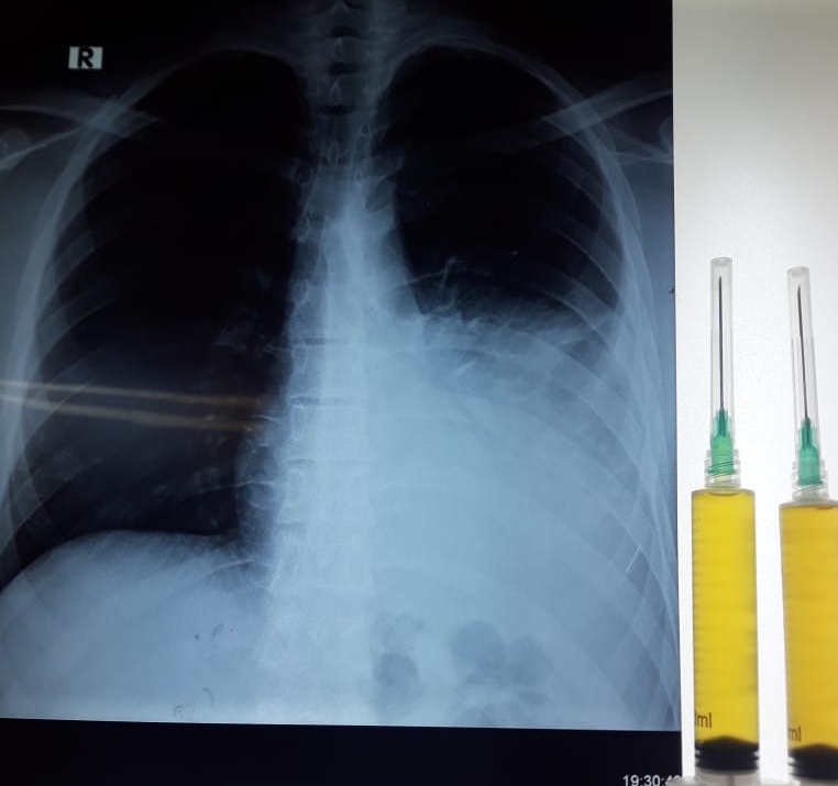 pleural effusion