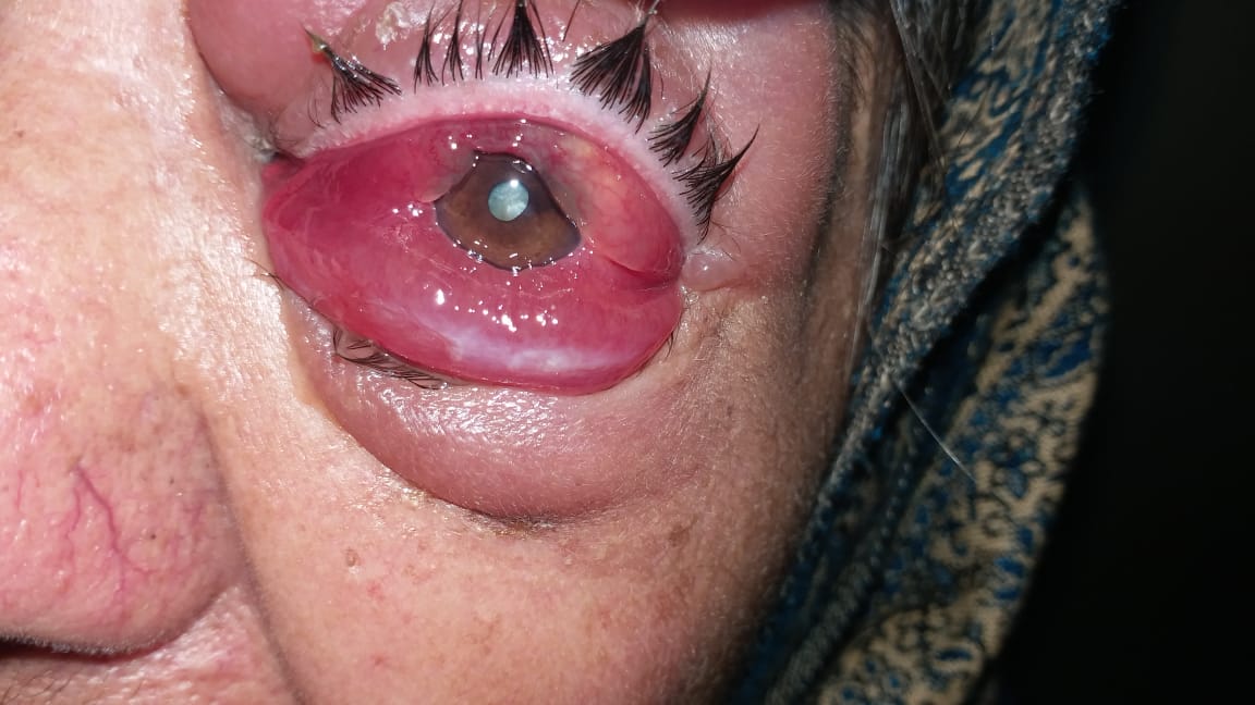 eye swelling