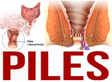 how to prevent and treat hemorrhoids