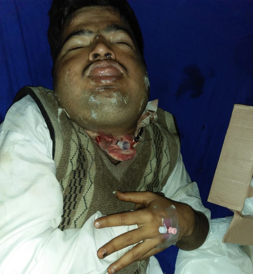 kala pathar poisoning
