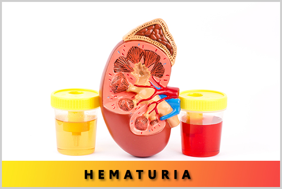 hematuria