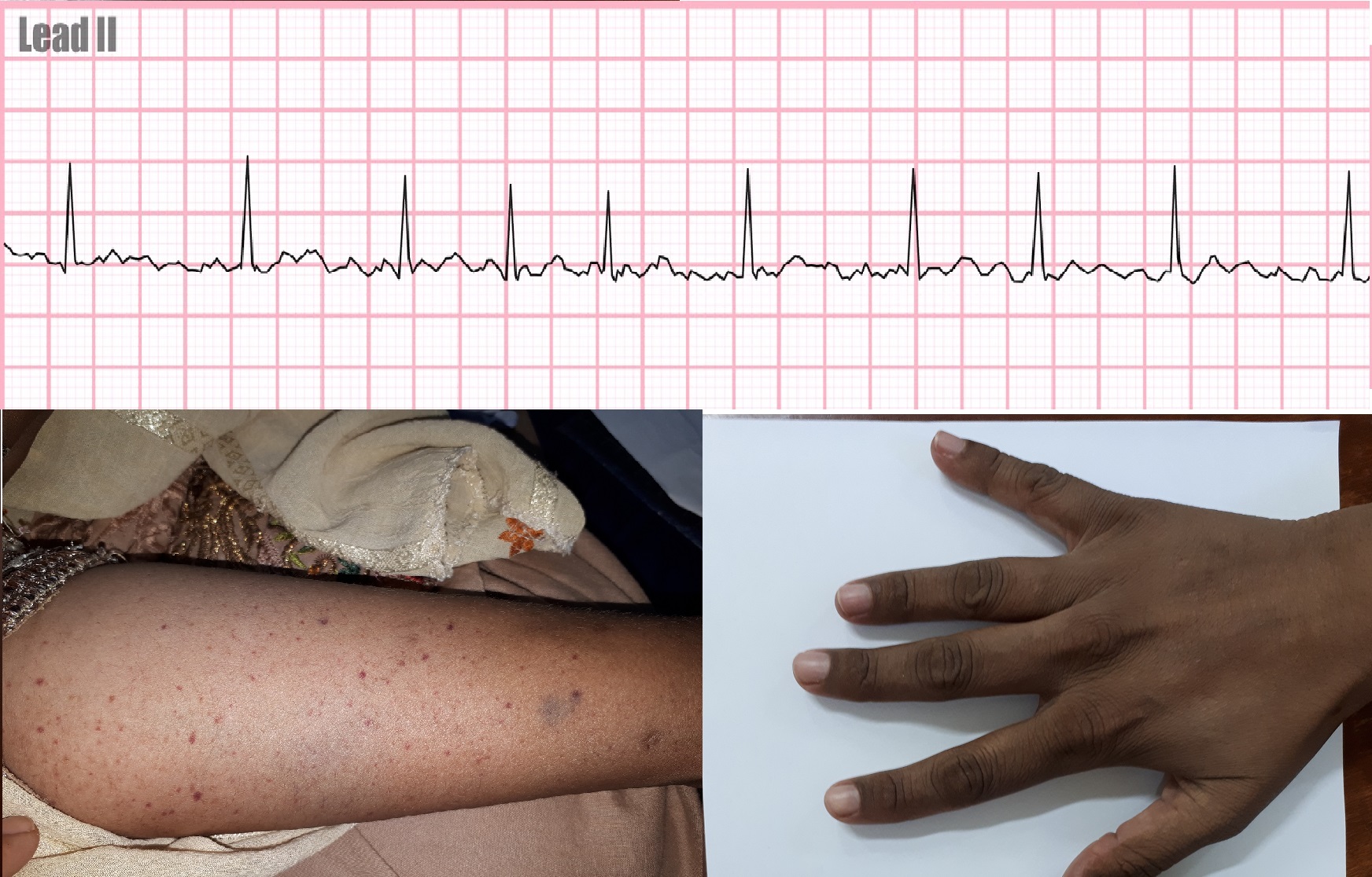 cardiomyopathy