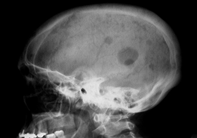 multiple myeloma symptoms