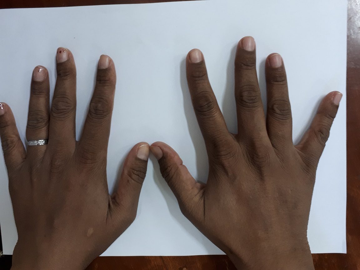 hemochromatosis symptoms hyperpigmentation