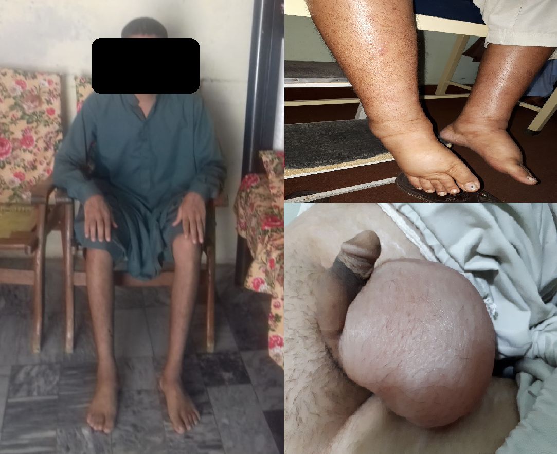 nephrotic syndrome