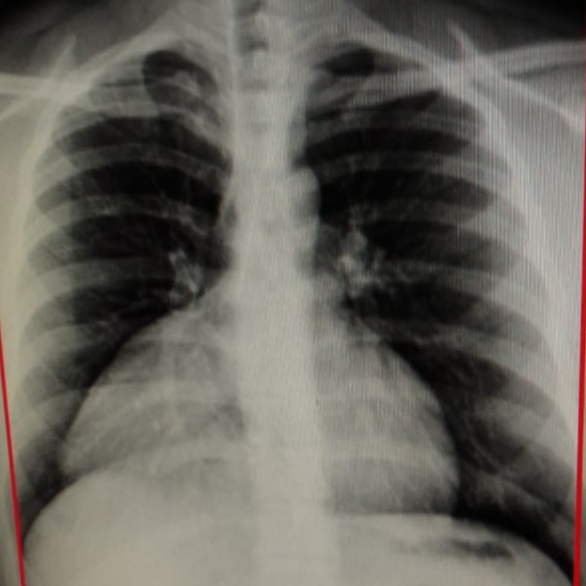 morgagni hernia bouts of cough